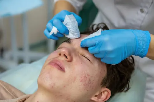 Acne Laser Treatment