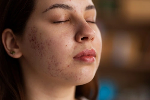 Acne & Scars Treatment